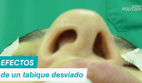 Efectos de un tabique desviado